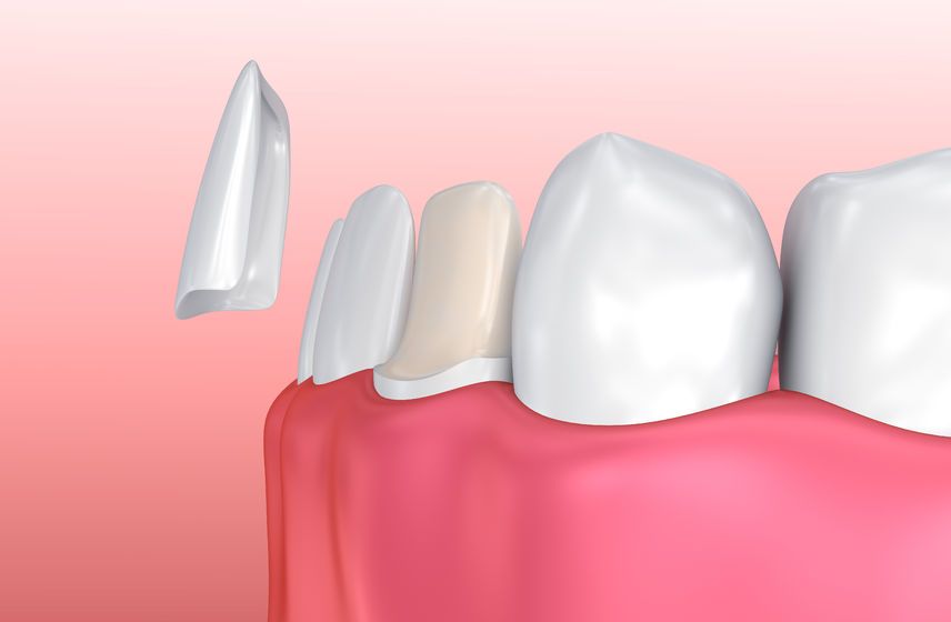 Faccette dentali in ceramica