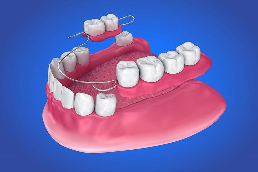 protesi Archivi - Dental One