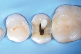 La ricostruzione con perni dei denti “devitalizzati” - Dental One