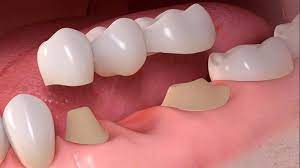 Ponte dentale cementato che si stacca: cosa fare - Dental One